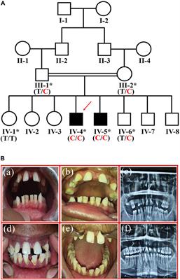 The First Report of a Missense Variant in RFX2 Causing Non-Syndromic Tooth Agenesis in a Consanguineous Pakistani Family